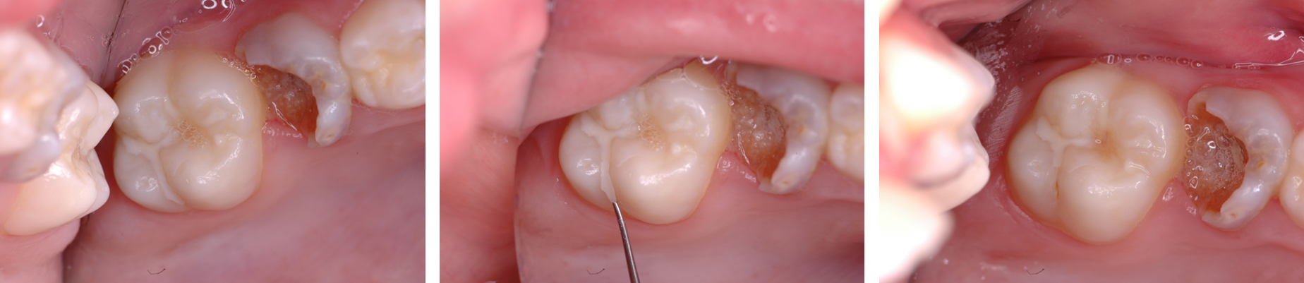 Images showing a fissure sealant being checked