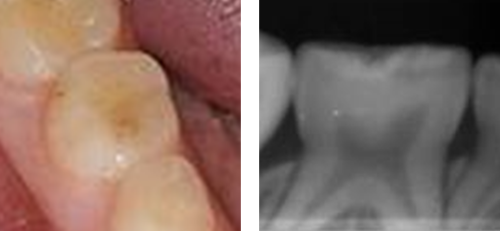 Photograph and radiograph of initial occlusal caries