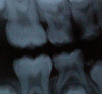 Radiograph showing dental caries in lower molar tooth