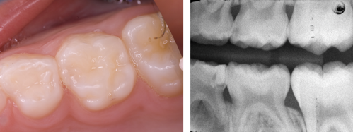 Image shows a photograph and radiograph of an upper molar tooth with caries