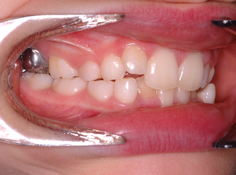 Photograph showing a pre-formed metal crown placed on a first permanent molar of poor prognosis