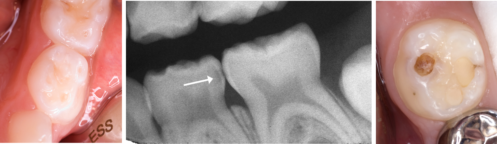 Images of teeth with carious lesions