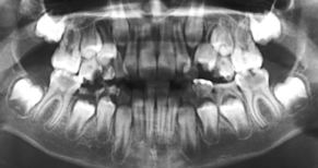 Panoramic radiograph