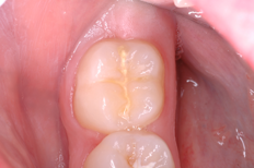 Image showing a tooth with a fissure sealant