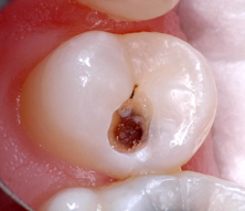 Image showing a tooth with a cavity prepared for restoration