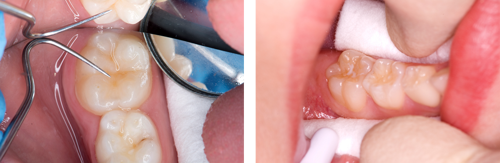 Images of teeth being cleaned and isolated in preparation for fissure sealant application