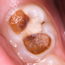 Image of a tooth with active caries