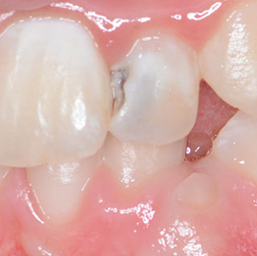 Photograph of an anterior tooth with advanced caries